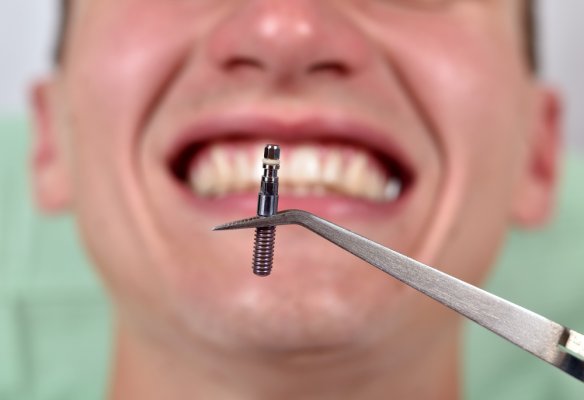 Turismo Dental En Turqu A Consejos Y Precios Para Implantes Dentales