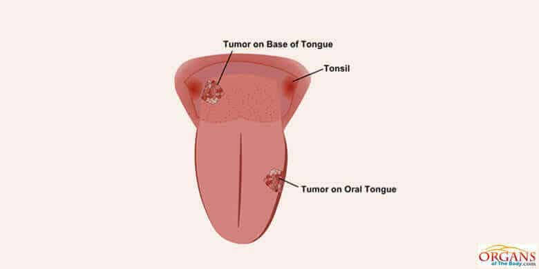 C Ncer De Lengua Conoce Los S Ntomas Causas Y Prevenci N