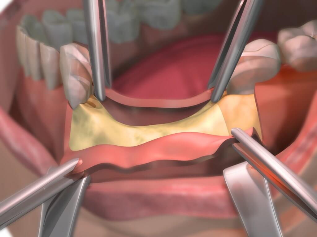 Qué es injerto de hueso dental tipos y para qué sirve