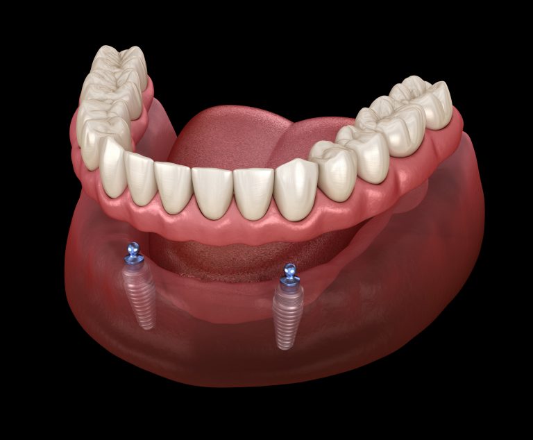 Sobredentadura Sobre Implantes Tipos Precios Ventajas Y Desventajas