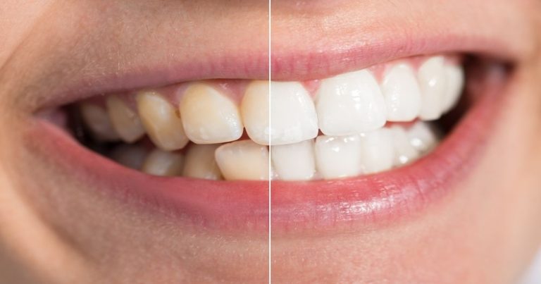 10 Foods That Stain Teeth And How To Prevent It