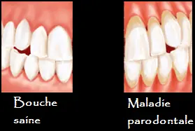 Maladie Parodontale : Tout Savoir Sur La Parodontite