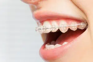 Frau lächelt mit weißen Zähnen und fester Zahnspange