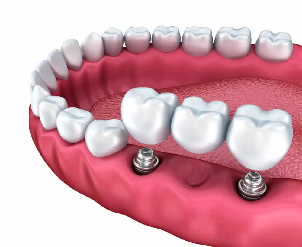 dentures-a-guide-to-types-of-false-teeth-their-costs-electric