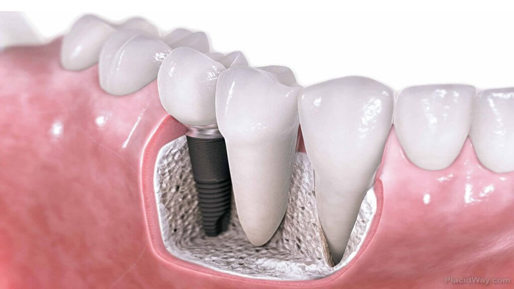 Dental Bridge Costs, Types and More (UK Tooth Bridge Guide)