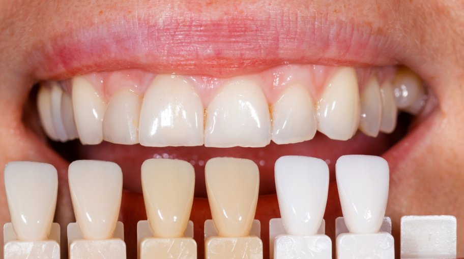 Dental Veneers Guide To Types Procedure And Costs In The Uk