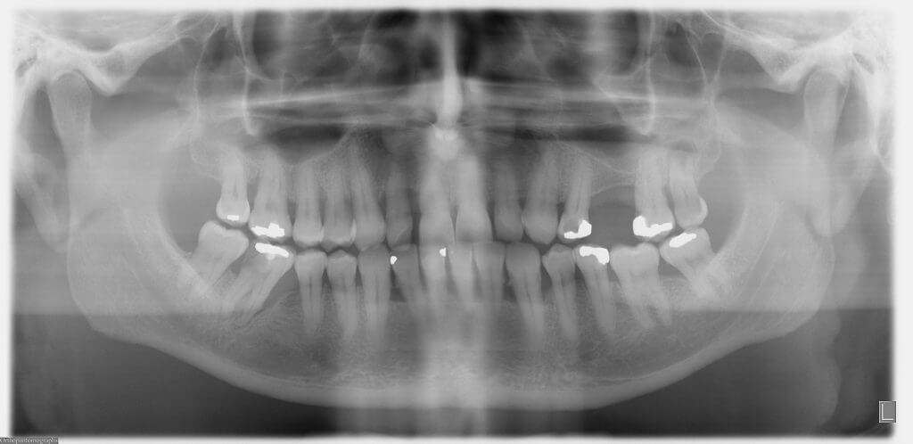 How to Get a Panoramic Dental X-Ray, Costs & Procedure