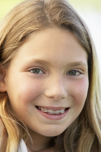 Braces for Kids: Costs and Different Types Offered in the UK
