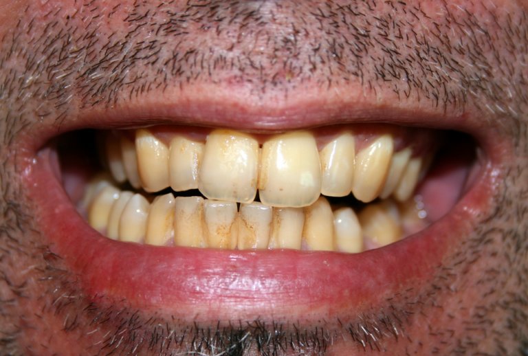 Why Are My Teeth Yellow? How to Get Rid of Yellow Stains