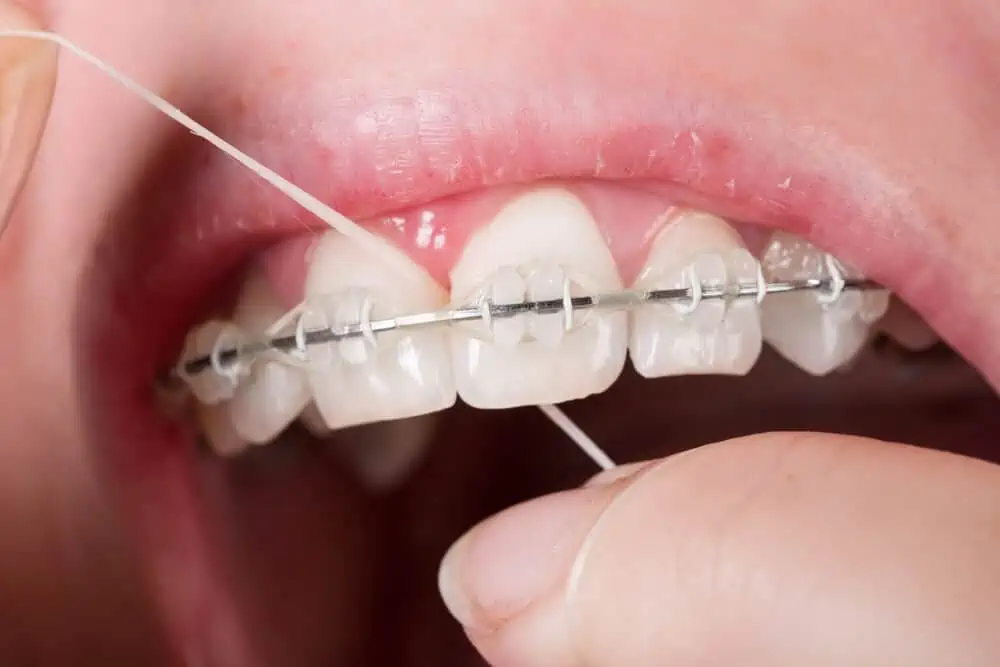 Flossing With Braces Orthodontic Floss & Other Options