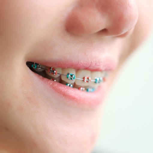 Coloured Braces: How They Work & How To Choose Your Colours