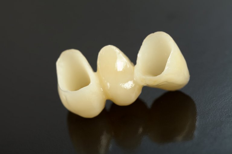 Dental Bridge Costs, Types and More (UK Tooth Bridge Guide)