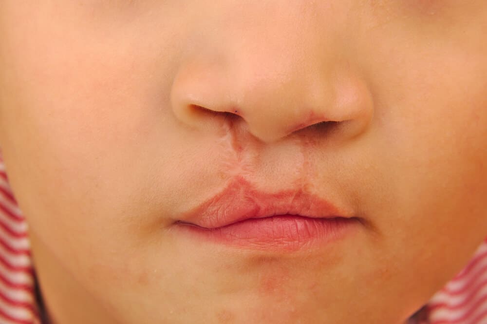 Cleft Palate And Cleft Lip Causes Treatments Surgery 