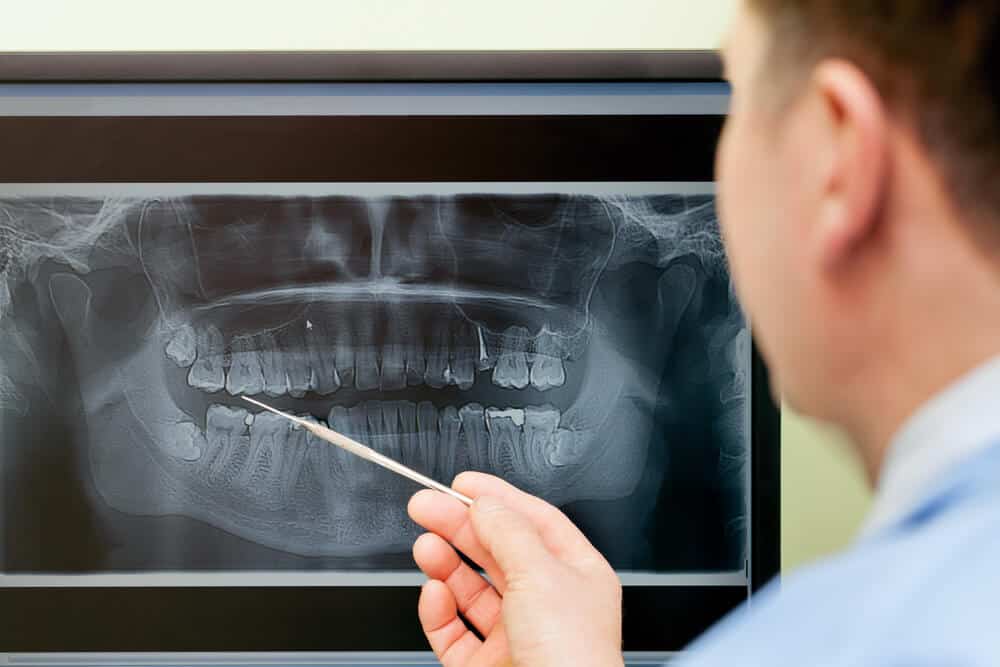 How to Get a Panoramic Dental XRay, Costs & Procedure