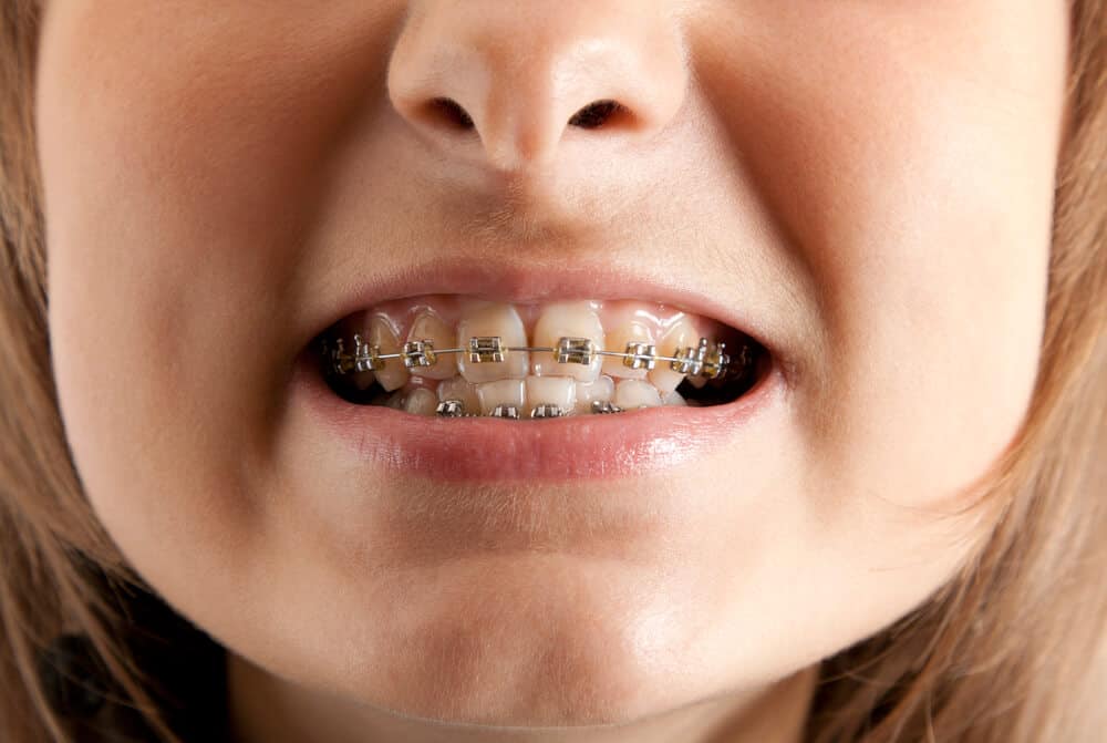 What Is Underbite And How Do You Correct It Braces Surgery