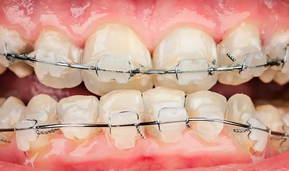 What is Underbite & How Do You Correct It Braces? Surgery?