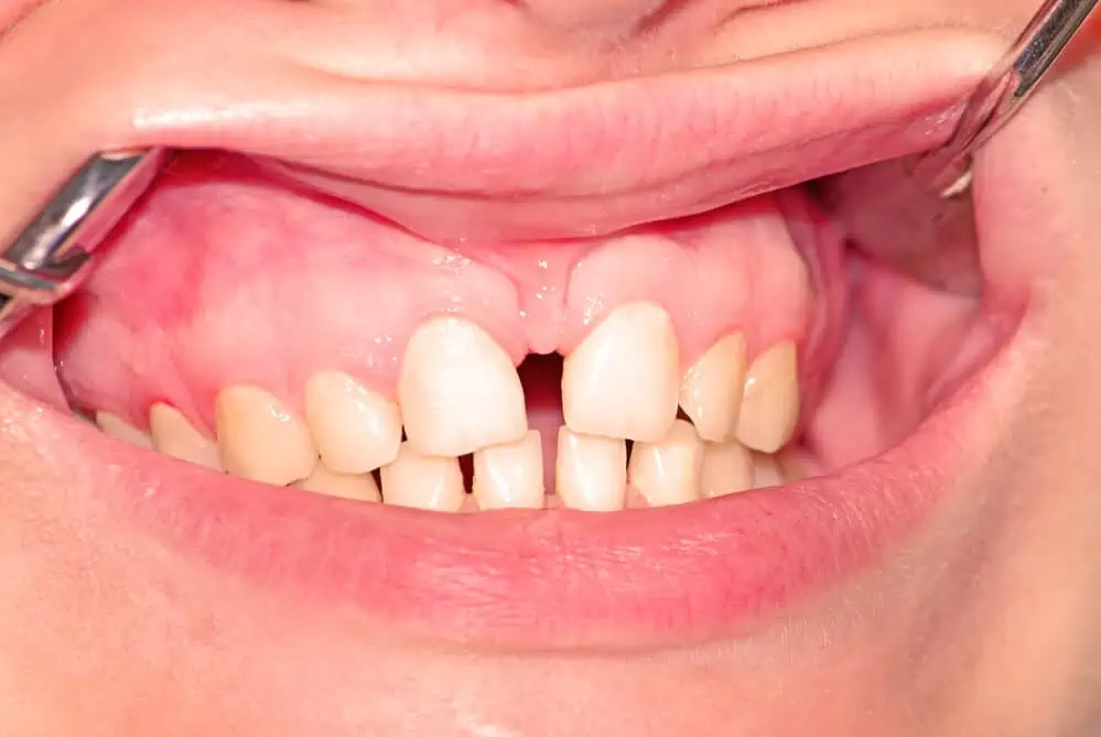 gapped teeth meaning