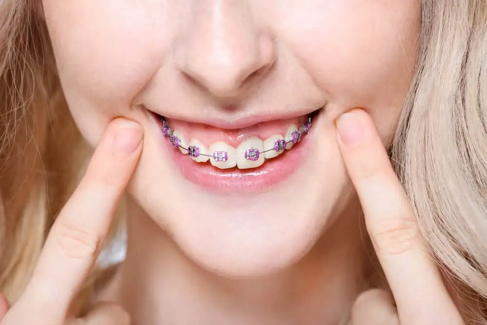 Teeth Straightening Costs & Options With or Without Braces