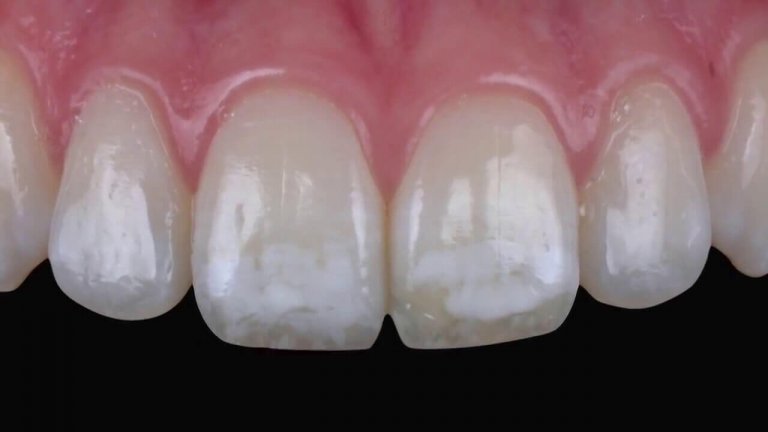 Dental Fluorosis: Too Much Fluoride, White Spots on Teeth