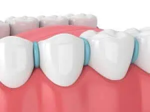 rubber dental spacers for braces