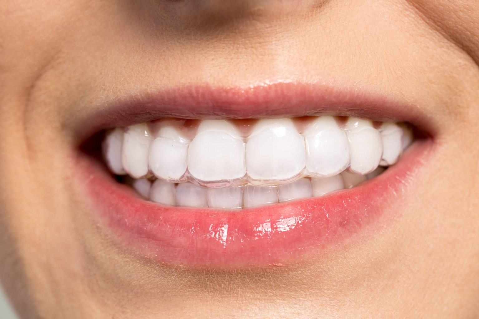 How Much Do Braces Cost In The Uk Guide To Different Types
