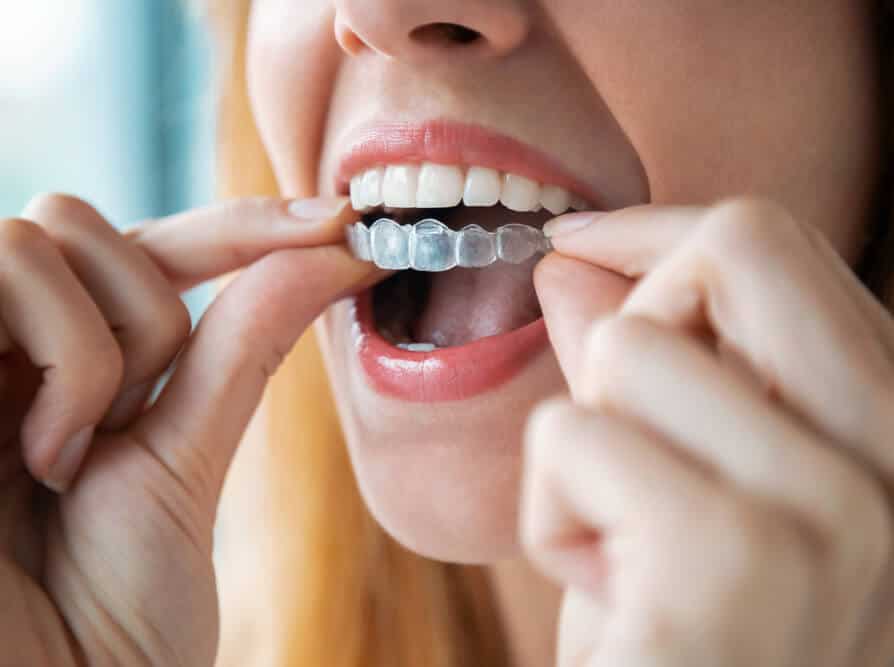 Best Removable Braces In The Uk Compare Brands And Costs
