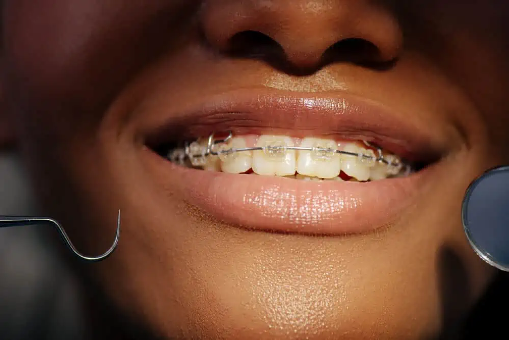 How Much Do Braces Cost in the UK? Guide to Different Types