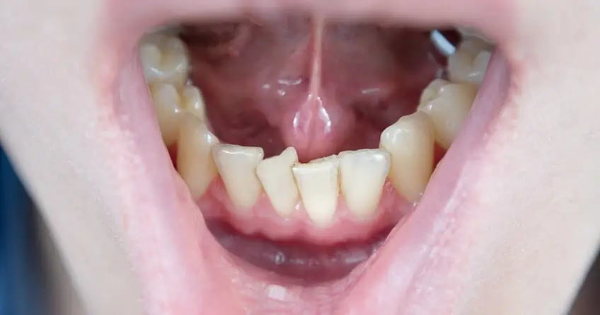 invisalign before and after worst cases