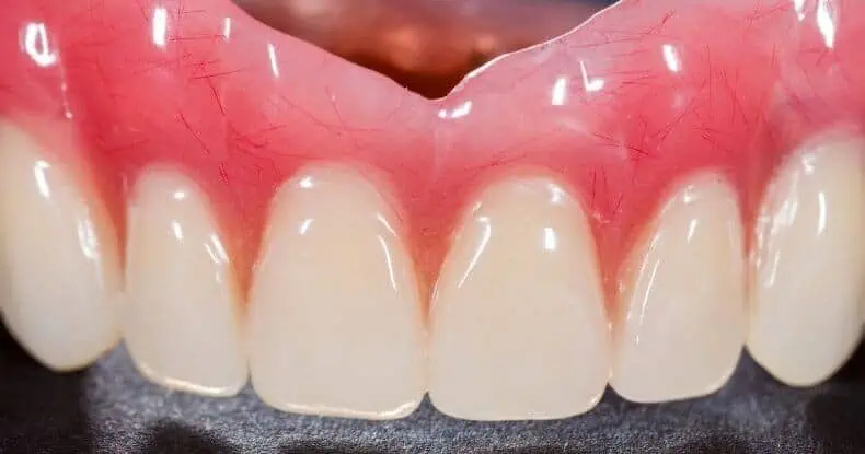 pictures of snap in dentures