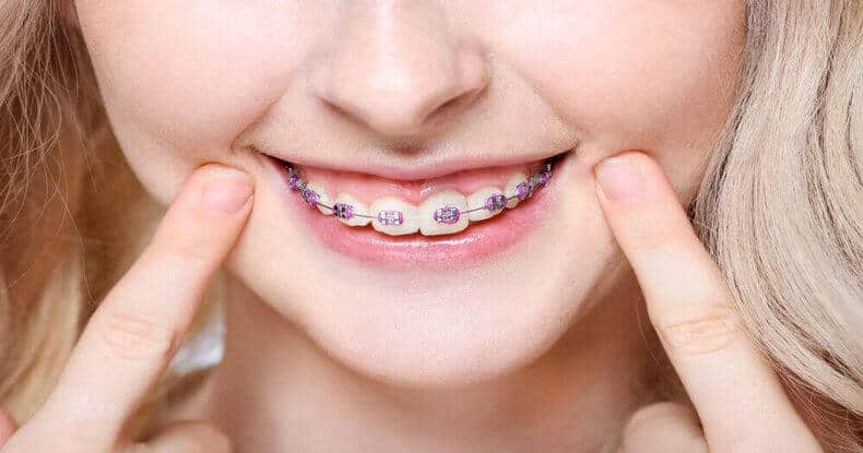 Fake Braces What Are They And Why Are They Popular