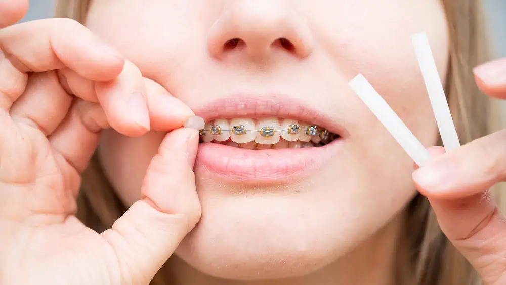 Do Braces Hurt? What to Expect and How to Find Relief From Braces Pain