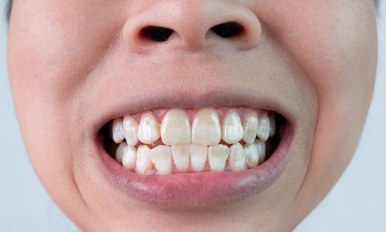 do-you-have-white-spots-on-teeth-here-s-how-you-can-overcome-them