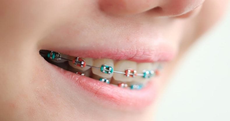 NHS Braces: Everything you Need to Know About NHS Orthodontics