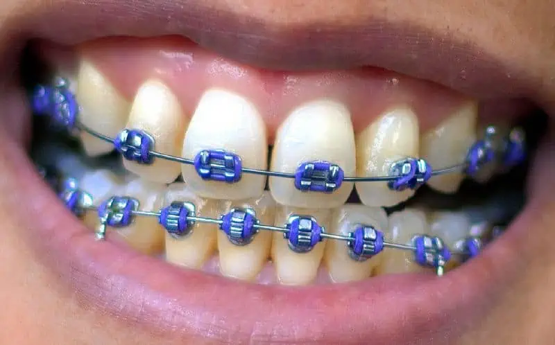 Brackets De Colores Las Mejores Combinaciones Y Tendencias 