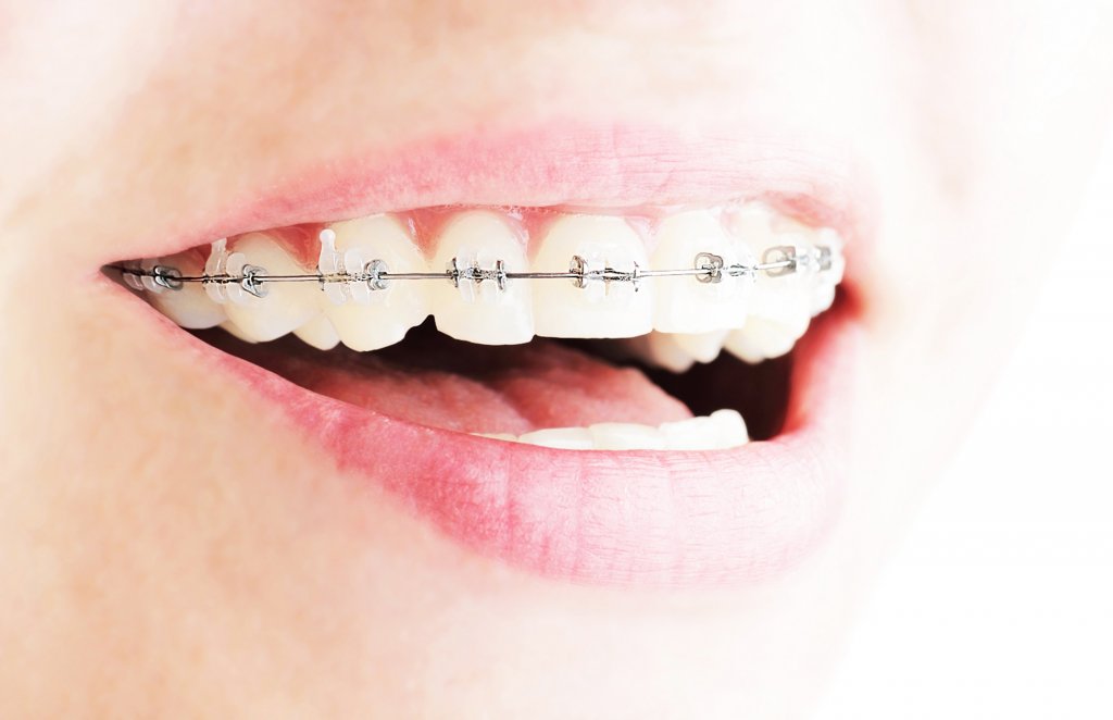 ¿Qué son los brackets de zafiro y cuál es su precio en España?