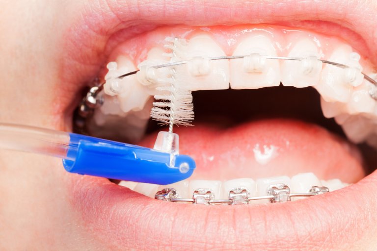 Gomas de Brackets: guía sobre las gomas de ortodoncia