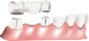 Puente Dental: Qué Es, Tipos Y Precio De Puentes Dentales