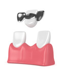 61841Las mejores marcas de implantes dentales en España