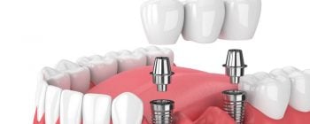 Cuántos implantes dentales se pueden poner al día