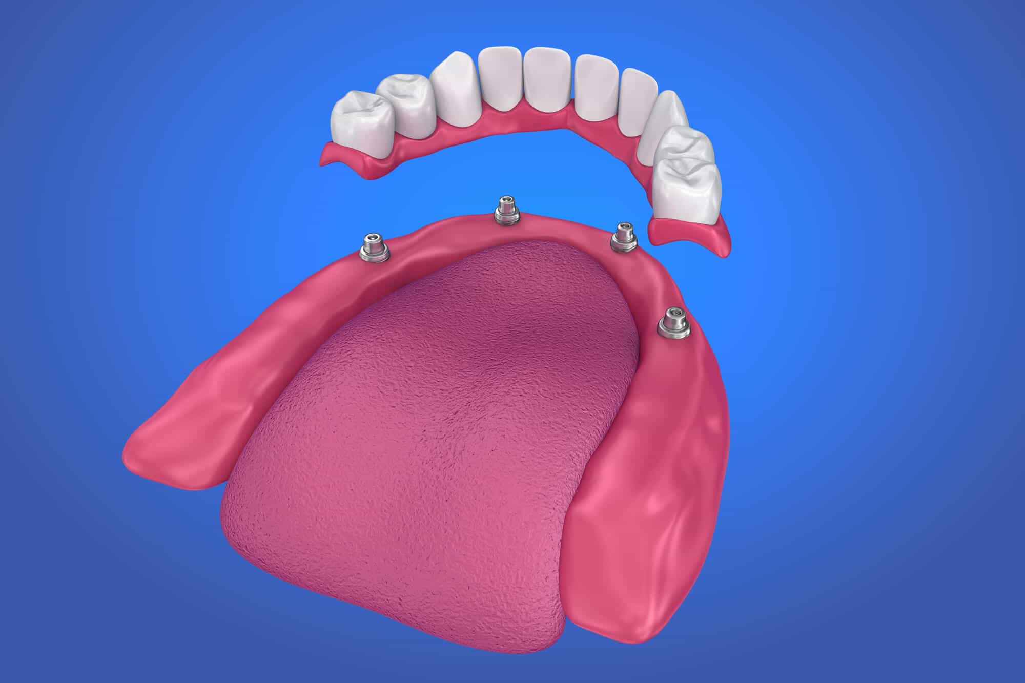 Prótesis Dentales Fijas Ventajas Y Desventajas De Las Dentaduras Fijas 9190