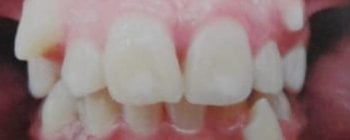 Maloclusión dental caracterizada por falta de espacio