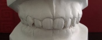 Cuando tus dientes superiores cubren más de lo debido tus dientes inferiores