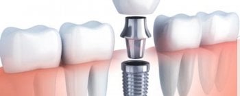 pasos para colocar un implante dental