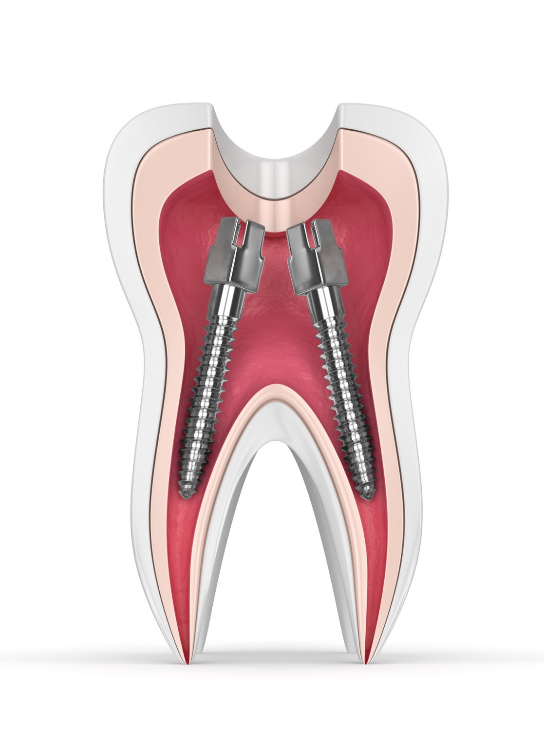 Perno Dental Precios: Tarifas actualizada [ 2024 ]