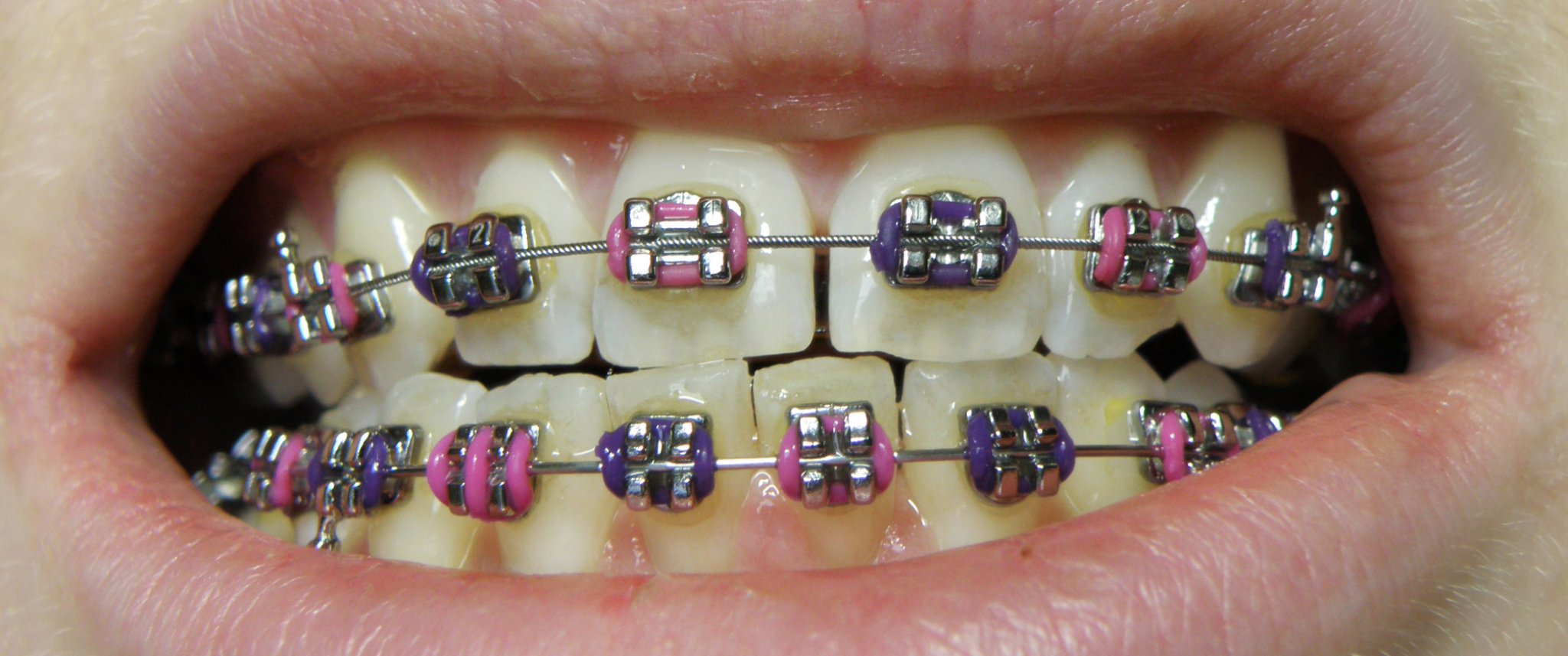 Brackets antes y después - Beneficios de usar ortodoncia