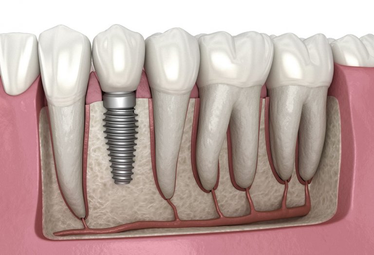 Implantes dentales sin hueso: soluciones y precios