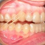 62355Antes y después de la maloclusión dental Clase 2