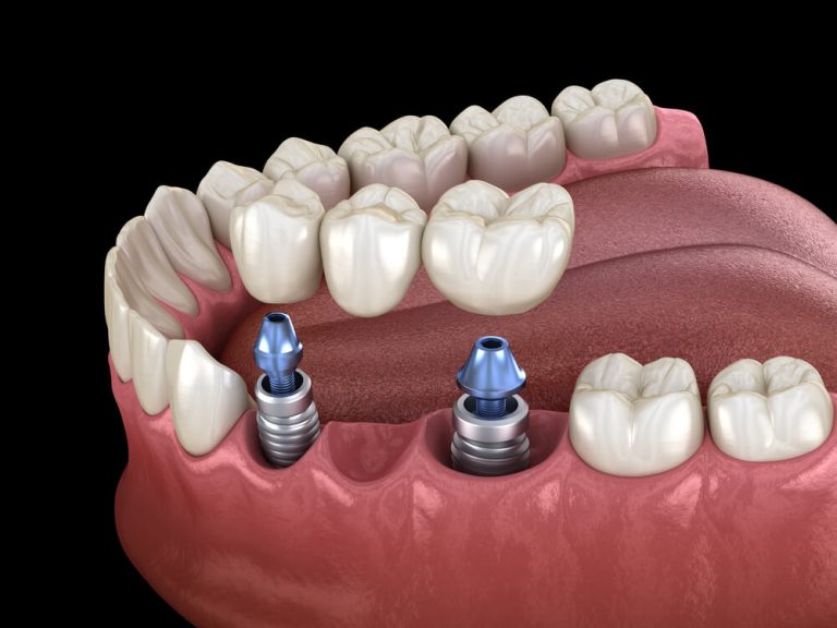 Puente Sobre Implantes Dentales: Para Qué Sirve, Ventajas Y Más