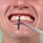 62938Las peores marcas de implantes dentales