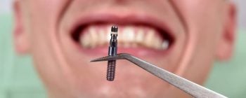Implantes dentales riesgos